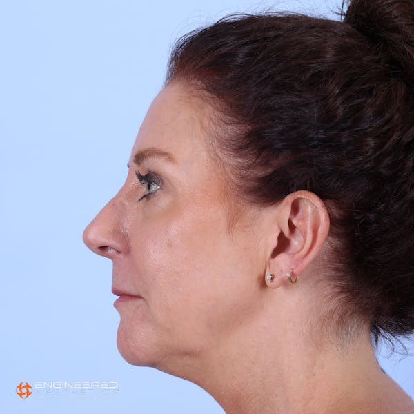 Fillers Before & After Gallery - Patient 147418449 - Image 7