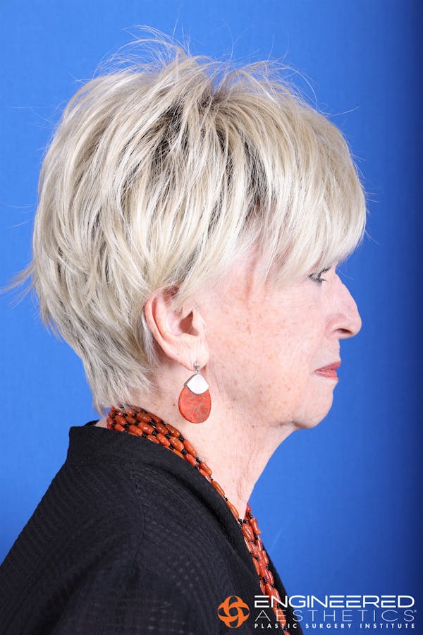 Neck Lift Before & After Gallery - Patient 149340920 - Image 5