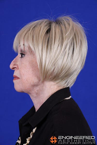 Neck Lift Before & After Gallery - Patient 149340920 - Image 10