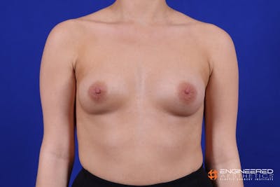 Breast Augmentation  Before & After Gallery - Patient 149341295 - Image 1