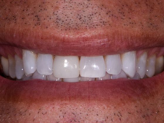 Full Mouth Reconstruction Before & After Gallery - Patient 3013897 - Image 1
