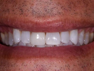 Full Mouth Reconstruction Before & After Gallery - Patient 3013897 - Image 1