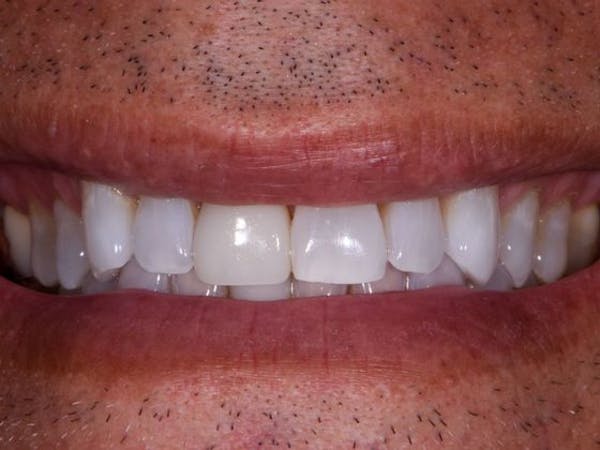 Tooth photo
