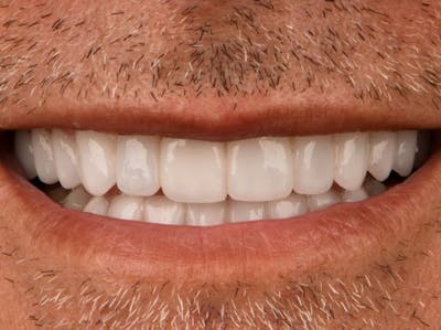 Full Mouth Reconstruction Before & After Gallery - Patient 3013897 - Image 2
