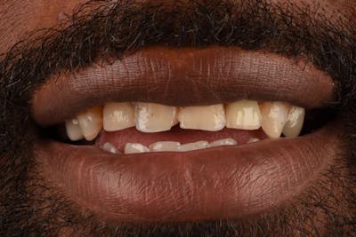 Full Mouth Reconstruction Before & After Gallery - Patient 3013898 - Image 1