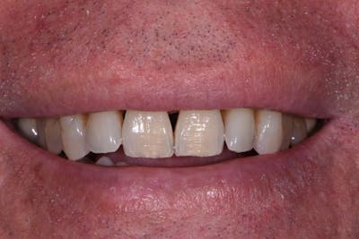 Full Mouth Reconstruction Before & After Gallery - Patient 3013900 - Image 1