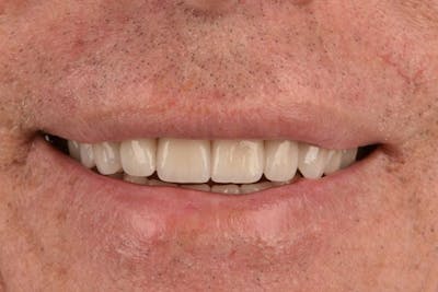 Full Mouth Reconstruction Before & After Gallery - Patient 3013900 - Image 2