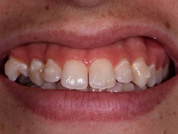 Bridges Before & After Gallery - Patient 3014732 - Image 1