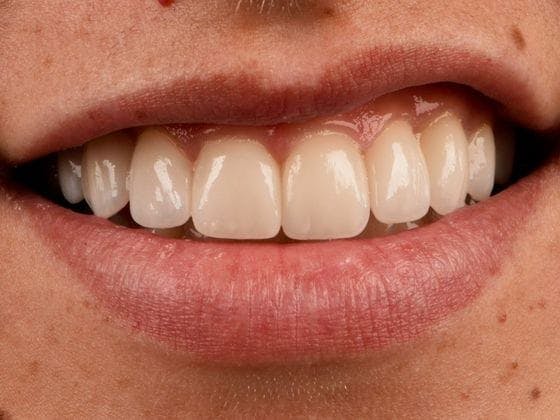 Bridges Before & After Gallery - Patient 3014732 - Image 2