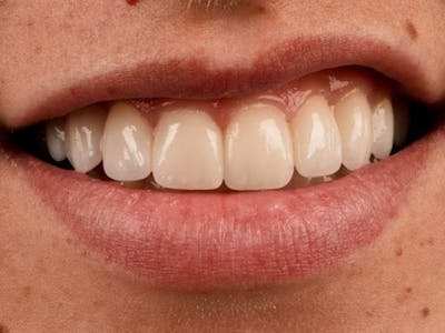 Bridges Before & After Gallery - Patient 3014732 - Image 2