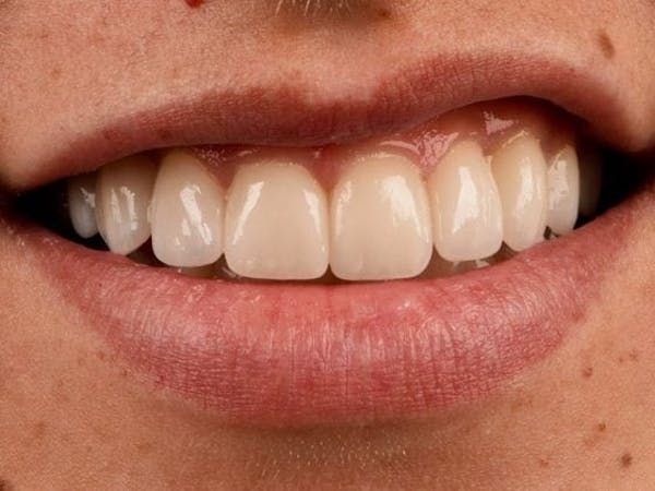 Bridges Before & After Gallery - Patient 3014732 - Image 2