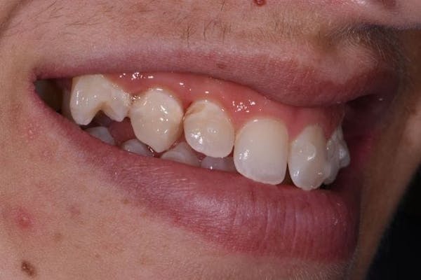Bridges Before & After Gallery - Patient 3014732 - Image 3