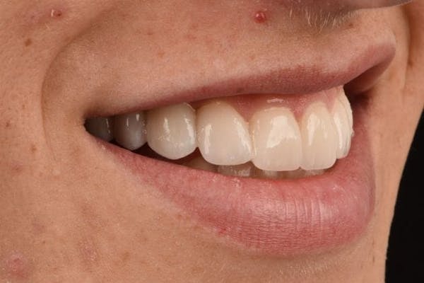 Bridges Before & After Gallery - Patient 3014732 - Image 4