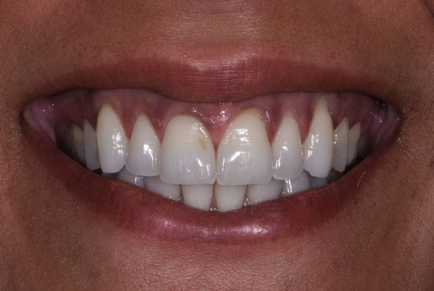 Before & After Dental Bonding