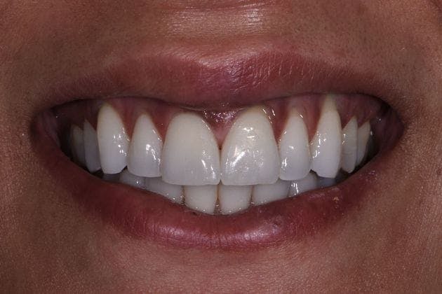 Composite Bonding Before & After Gallery - Patient 3014835 - Image 2