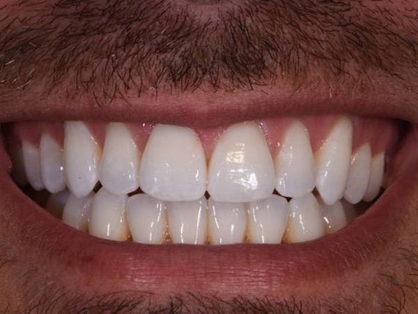 Tooth photo