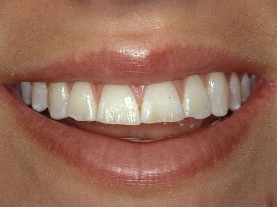 Before & After Veneers