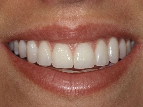 Before & After Veneers