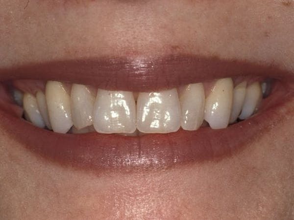 Porcelain Veneers Before & After Gallery - Patient 3015146 - Image 1