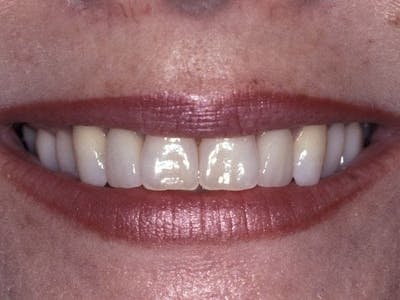 Porcelain Veneers Before & After Gallery - Patient 3015146 - Image 2