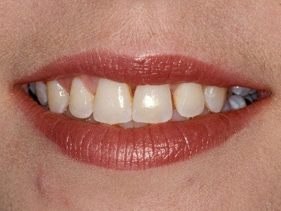 Porcelain Crowns Before & After Gallery - Patient 3015207 - Image 1