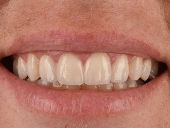 Before & After Dental Implants