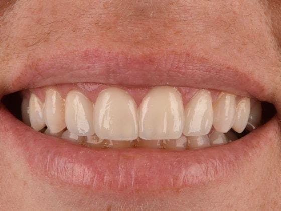 Dental Implants Before & After Gallery - Patient 3015355 - Image 2