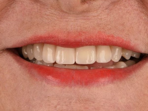 Dental Implants Before & After Gallery - Patient 3015356 - Image 2