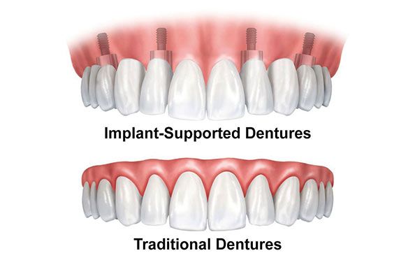 Dentures diagram