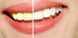 Charleston Teeth Whitening Side Effects