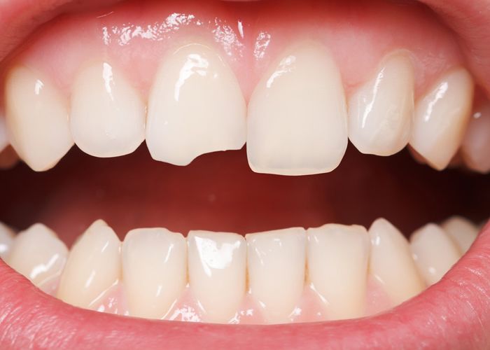 A close-up of a chipped front tooth