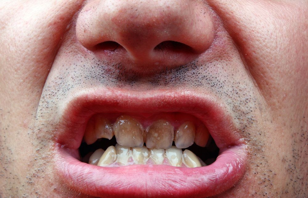 A man with a smile affected by smoking