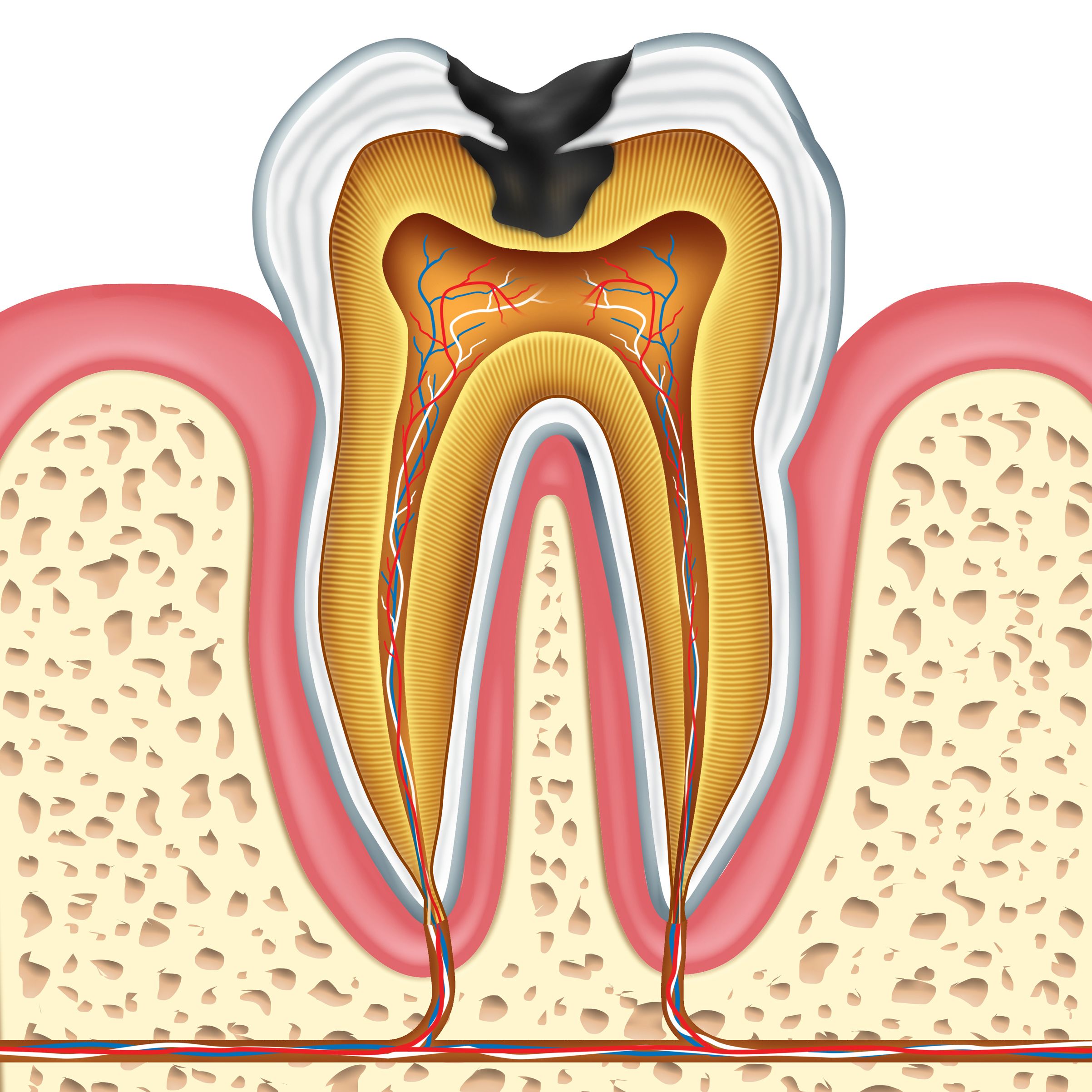 How cavities can affect a tooth's structure