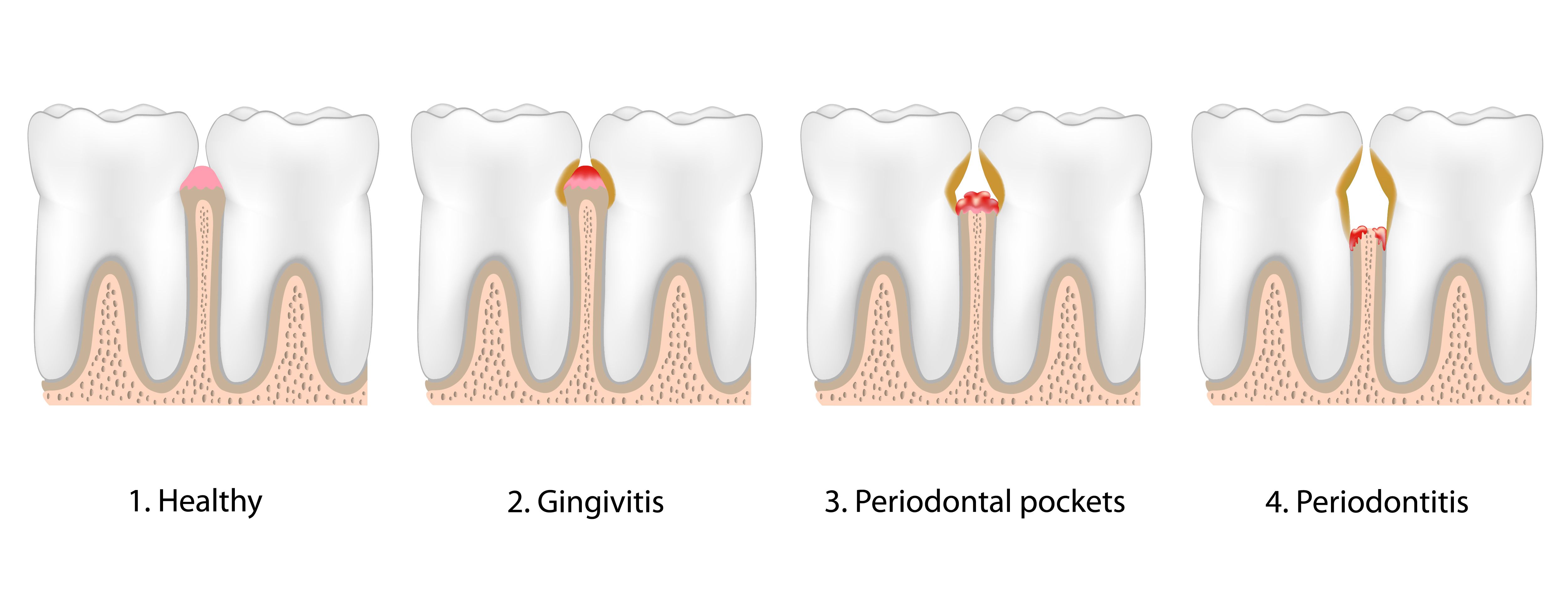 Illustrated chart showing the stages of gum disease