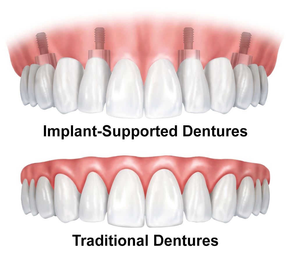 Implant-supported dentures and traditional dentures