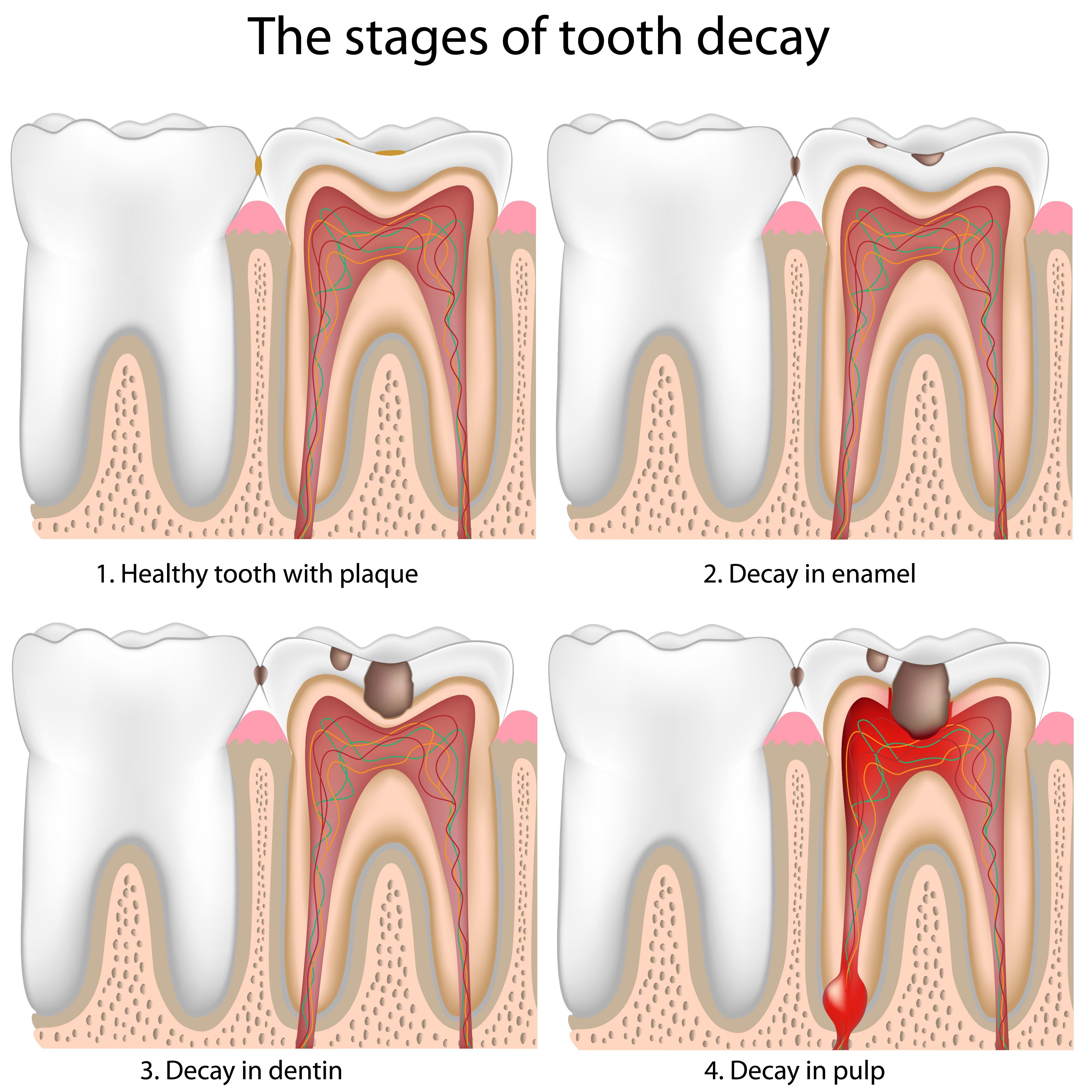 The stages of tooth decay progression