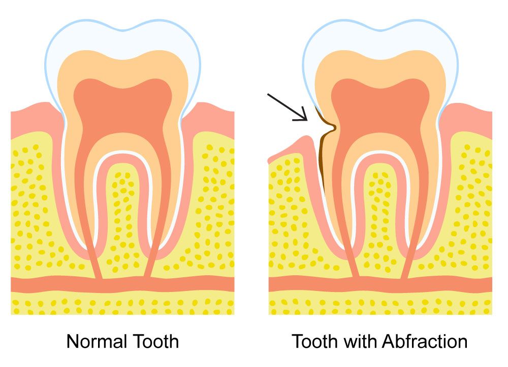 Dental Abfractions