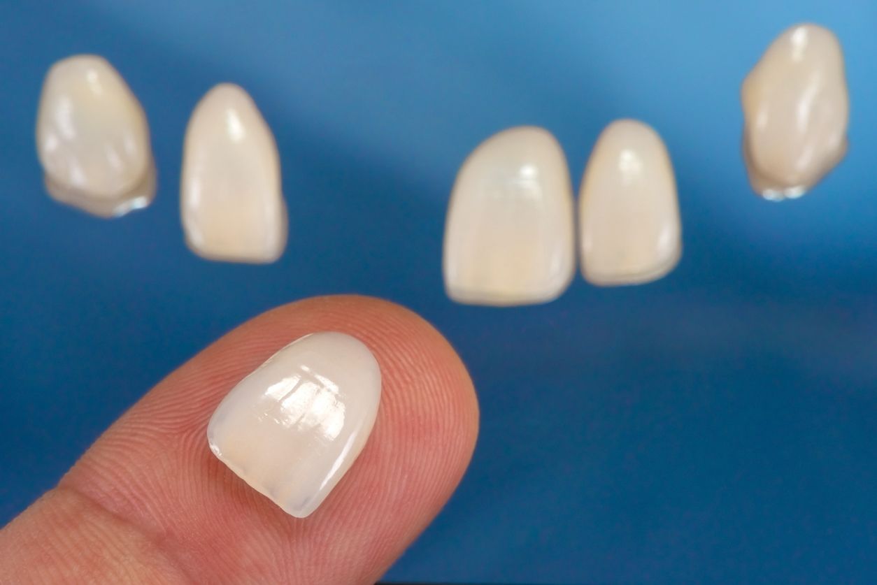 A set of porcelain veneers