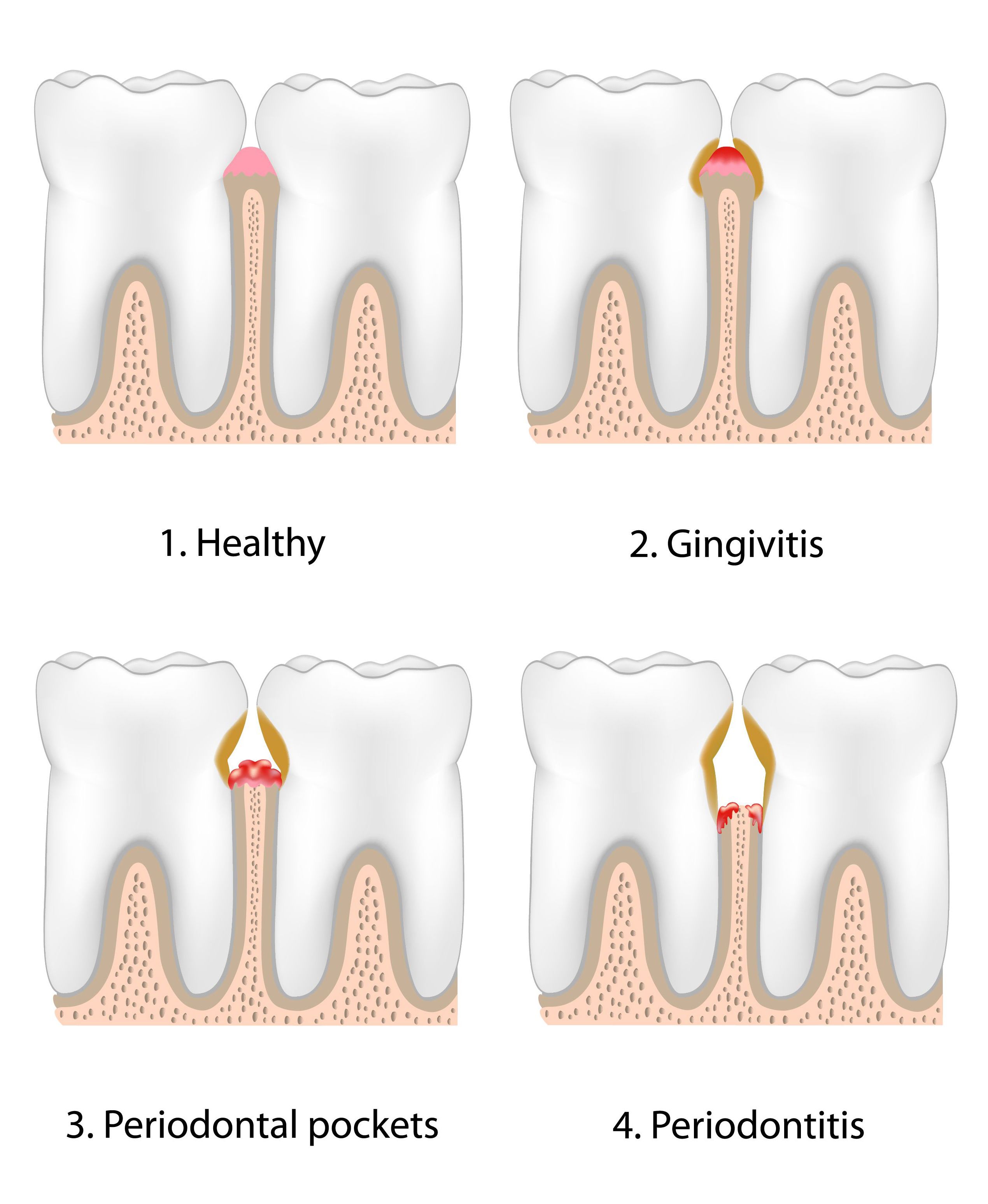 Four-panel illustration of the stages of gum disease