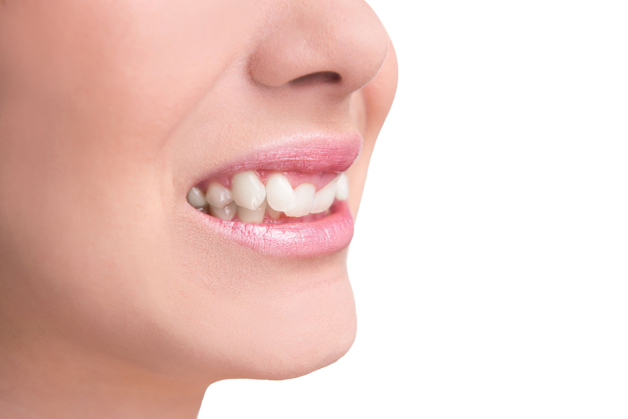 Photo of woman’s smile with twisted tooth