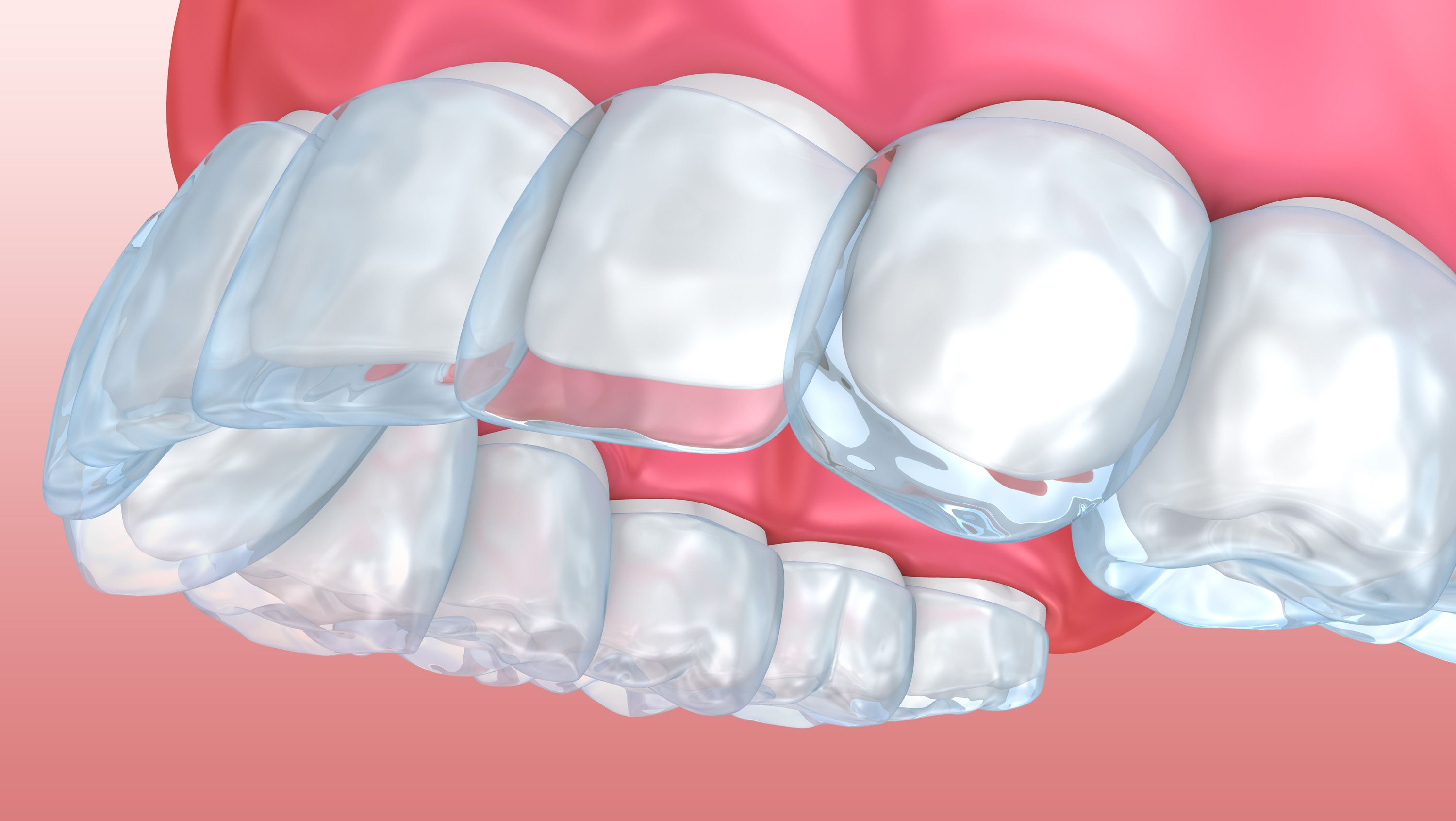 Invisalign aligner trays on the upper teeth