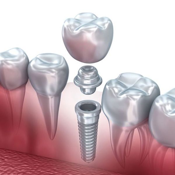 Implant-supported dental crown