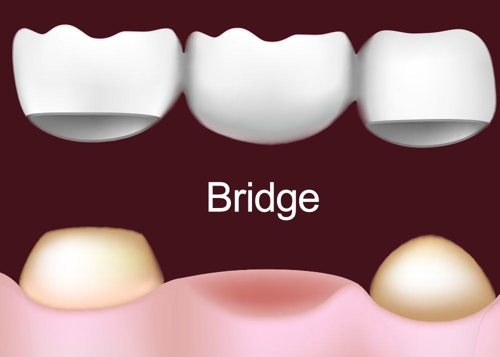 Illustration of a dental bridge