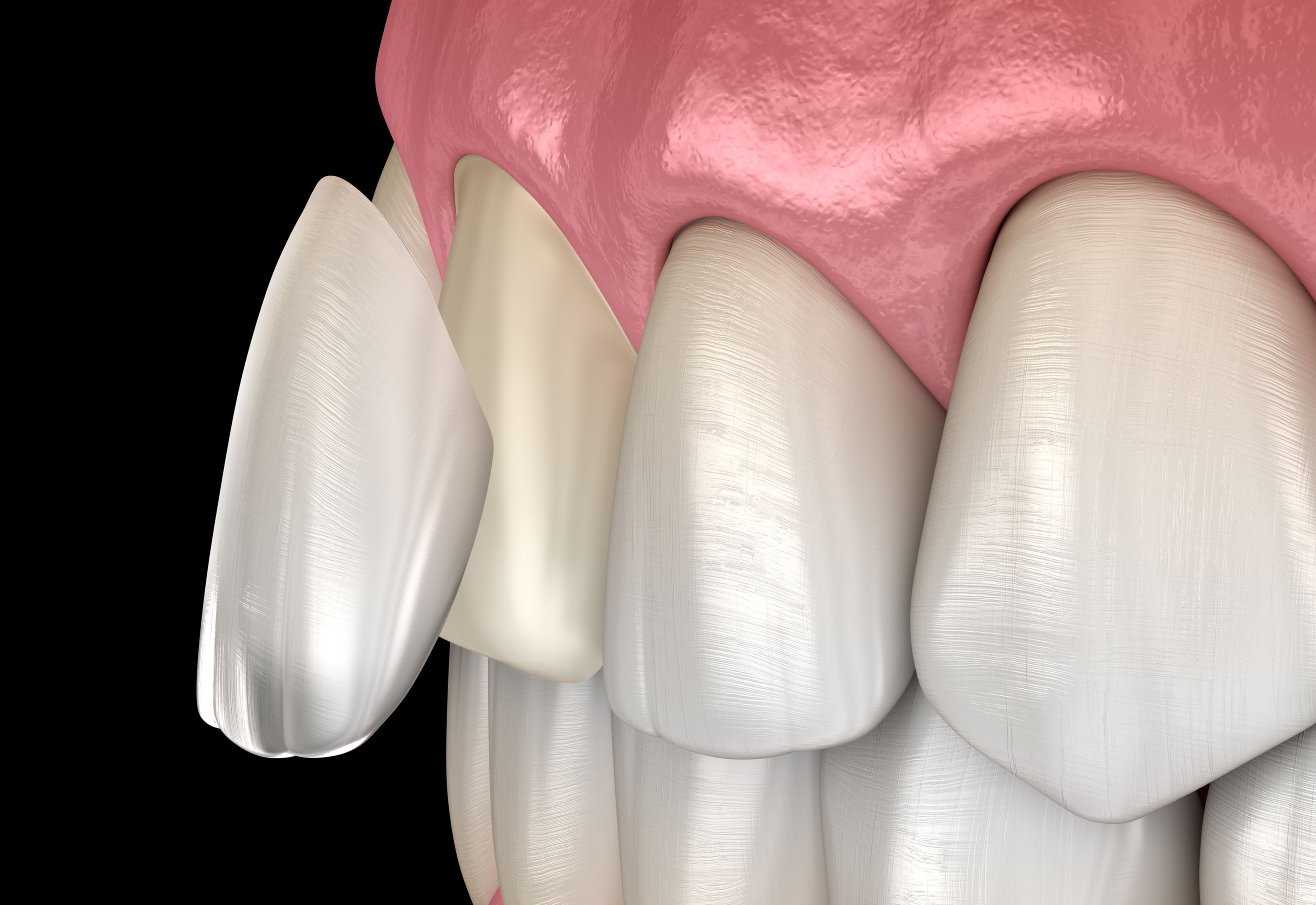 A porcelain dental veneer