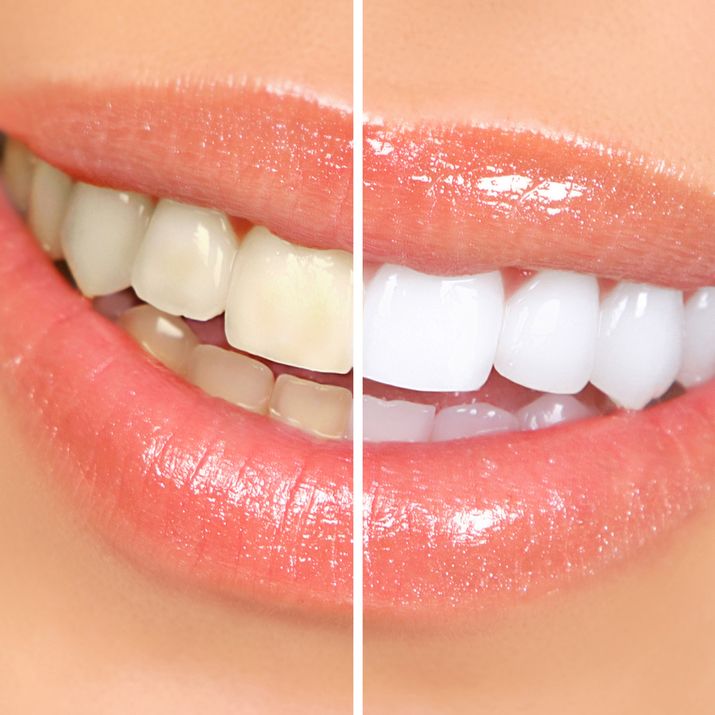 Teeth whitening results