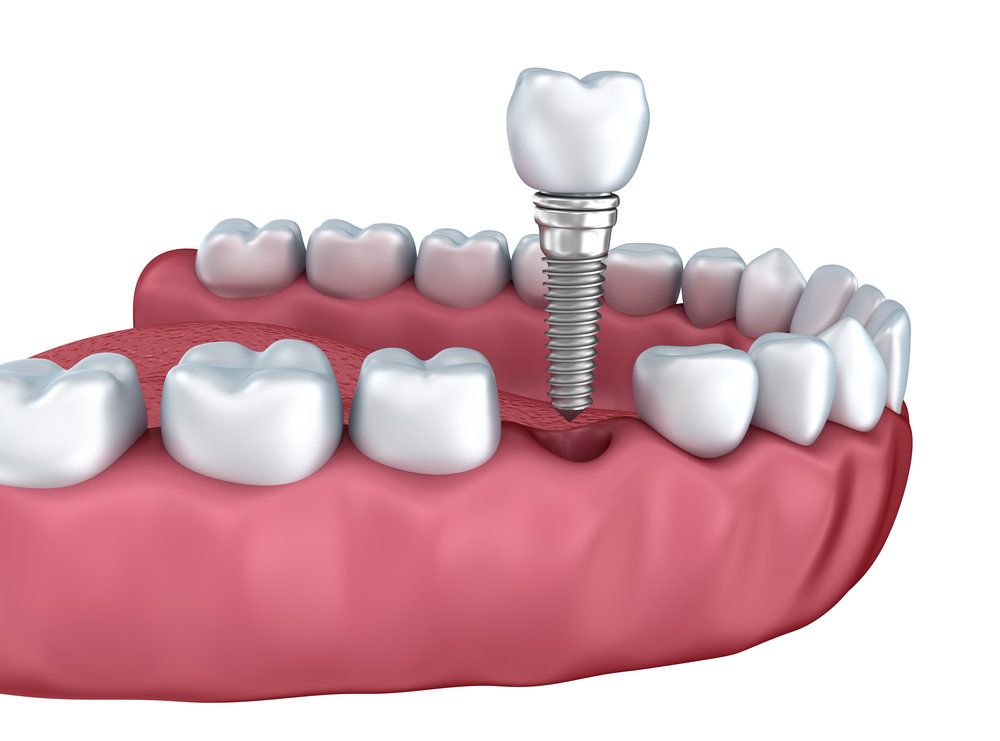 Dental implant placement