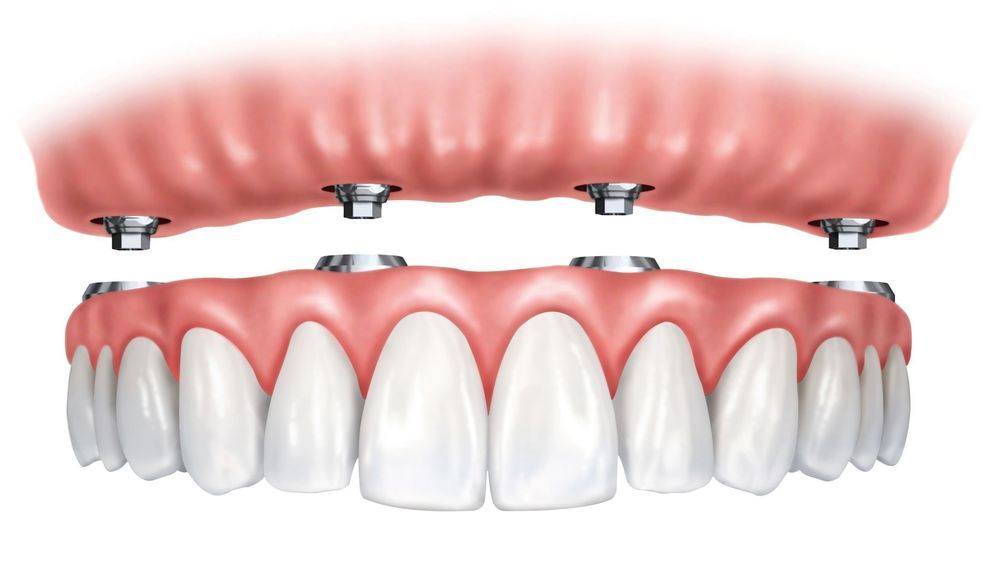 Implant diagram