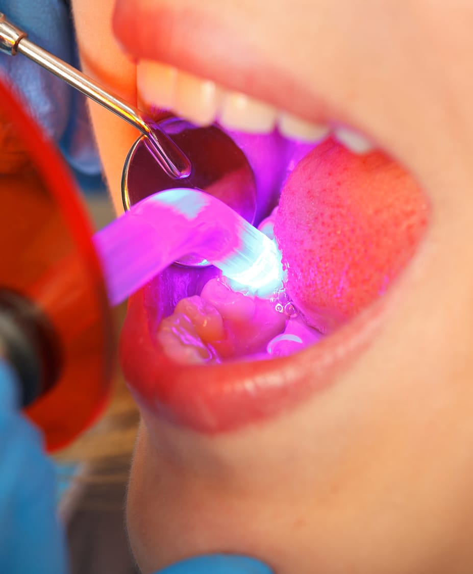 Dental Bonding Charleston Center For Cosmetic Dentistry