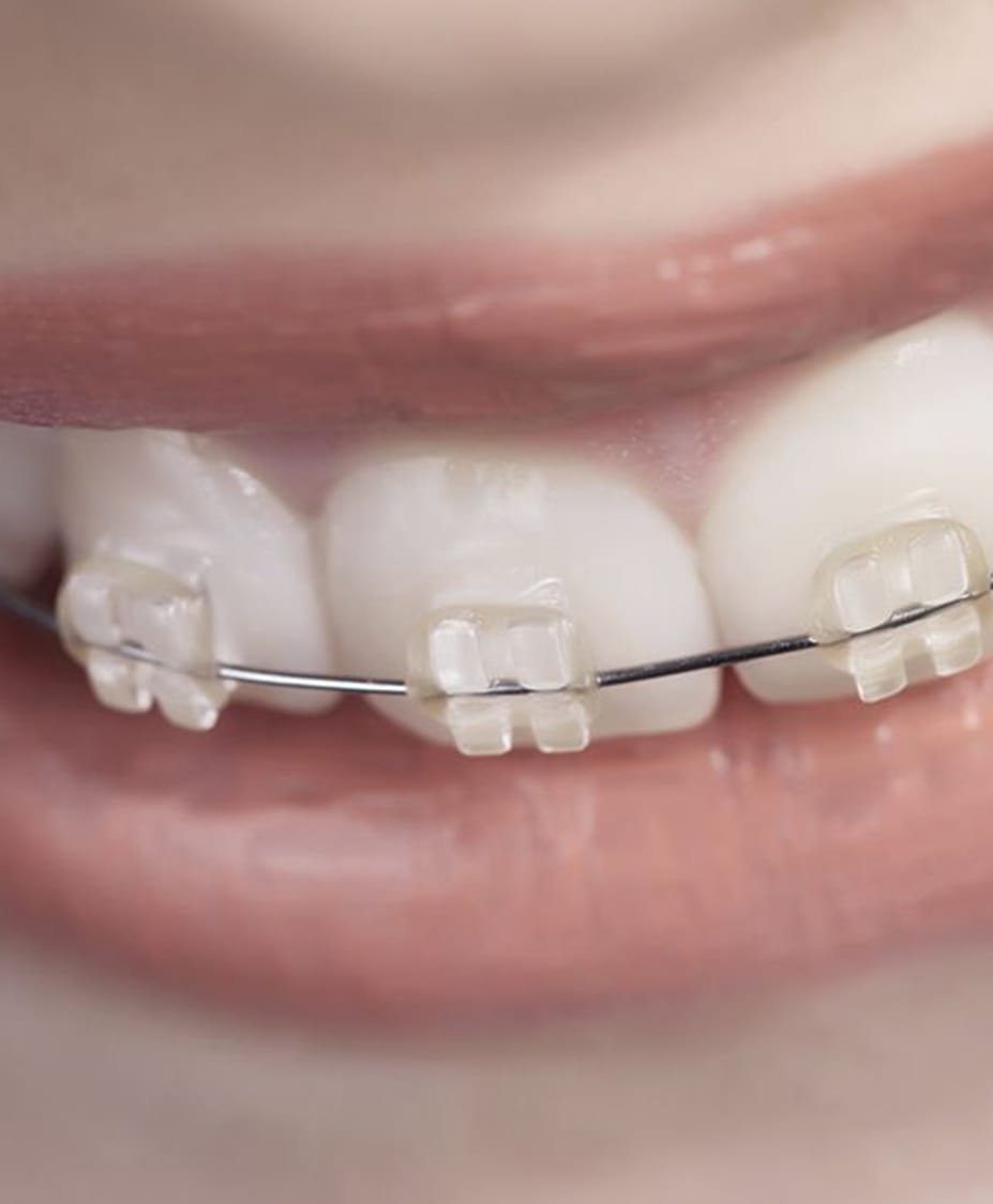 Invisalign Alternatives Charleston Center For Cosmetic Dentistry