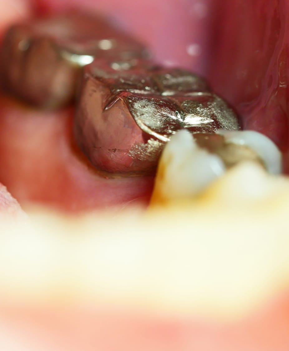 Dental Fillings Charleston SC Dr. John F. Rink